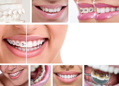 Phương pháp niềng răng mắc cài hiệu quả không?