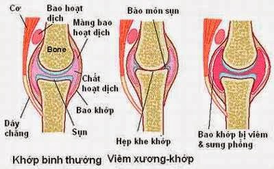 NHỮNG LƯU Ý KHI DÙNG THUỐC VIÊM KHỚP DẠNG THẤP NHỮNG LƯU Ý KHI DÙNG THUỐC VIÊM KHỚP DẠNG THẤP