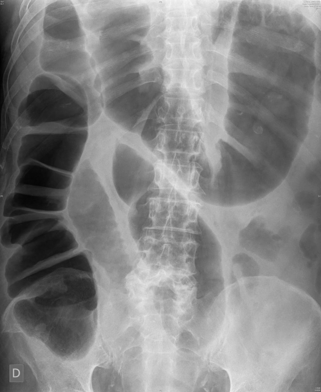 Docencia Alto Palancia Sindrome de Ogilvie
