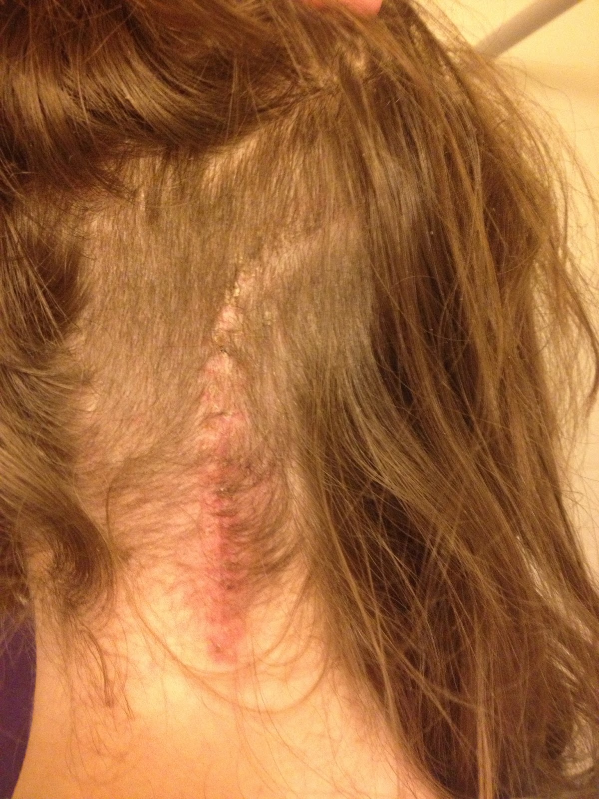 Living the Chronically Wonderful Life POTS, EDS, gastroparesis, and