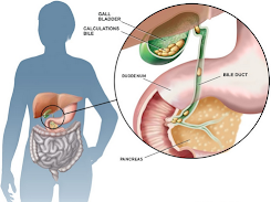 Obat Kolesistitis Herbal Obat Kolesistitis Herbal