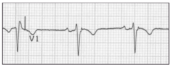 Absorb Medicine: Epsilon Waves in Arrhythmogenic Right Ventricular ...