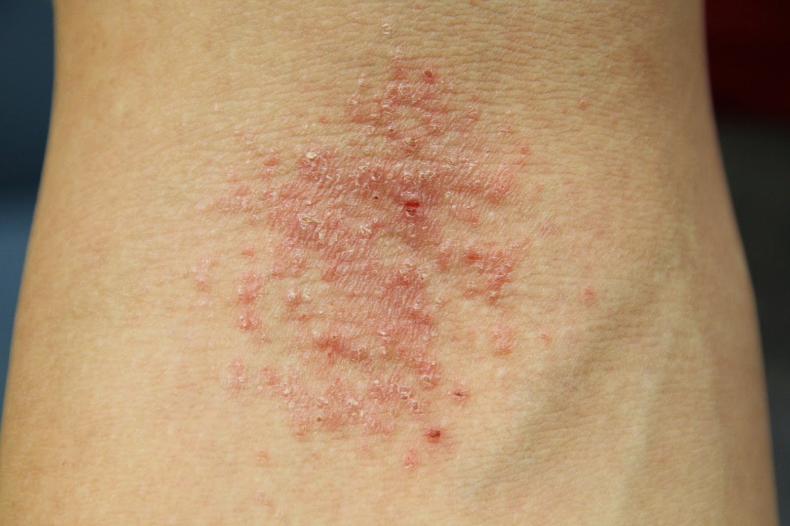 raised rash under armpit #10