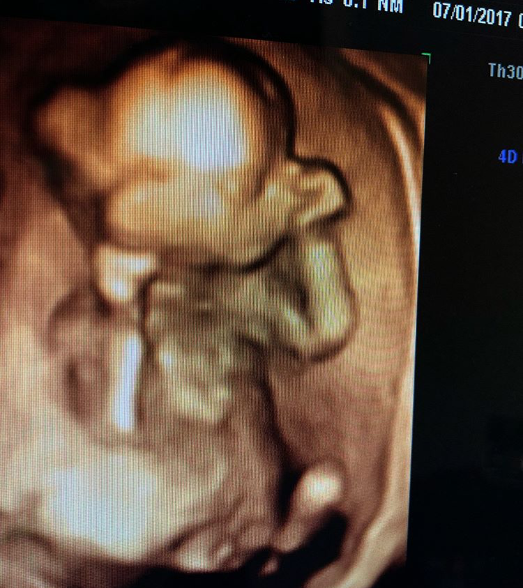 16 Hafta Gebelik Goruntusu