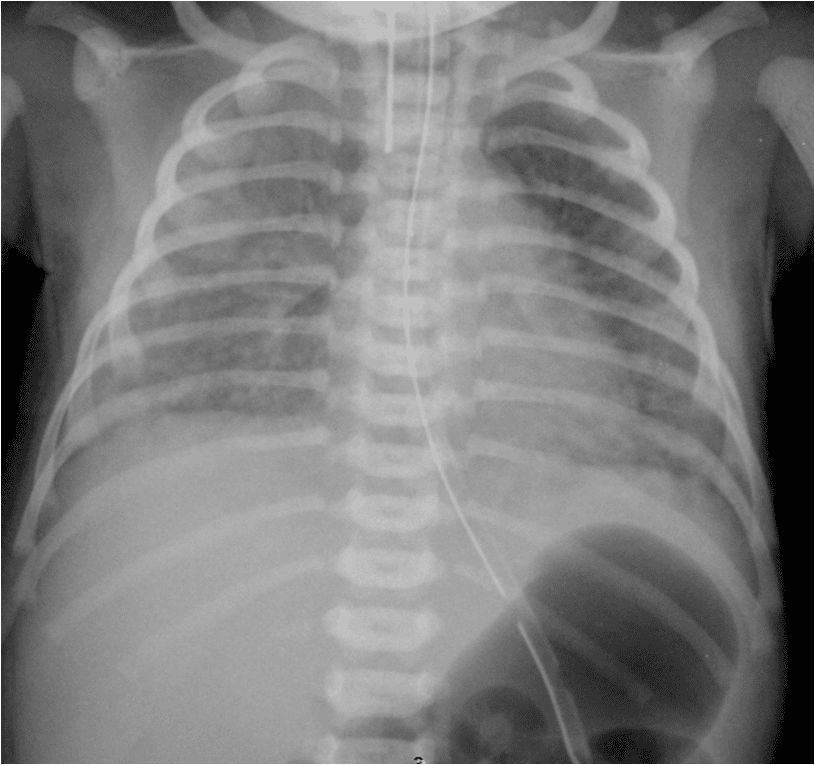 RADIOLOGY IMAGE SPOTTERS Meconium aspiration