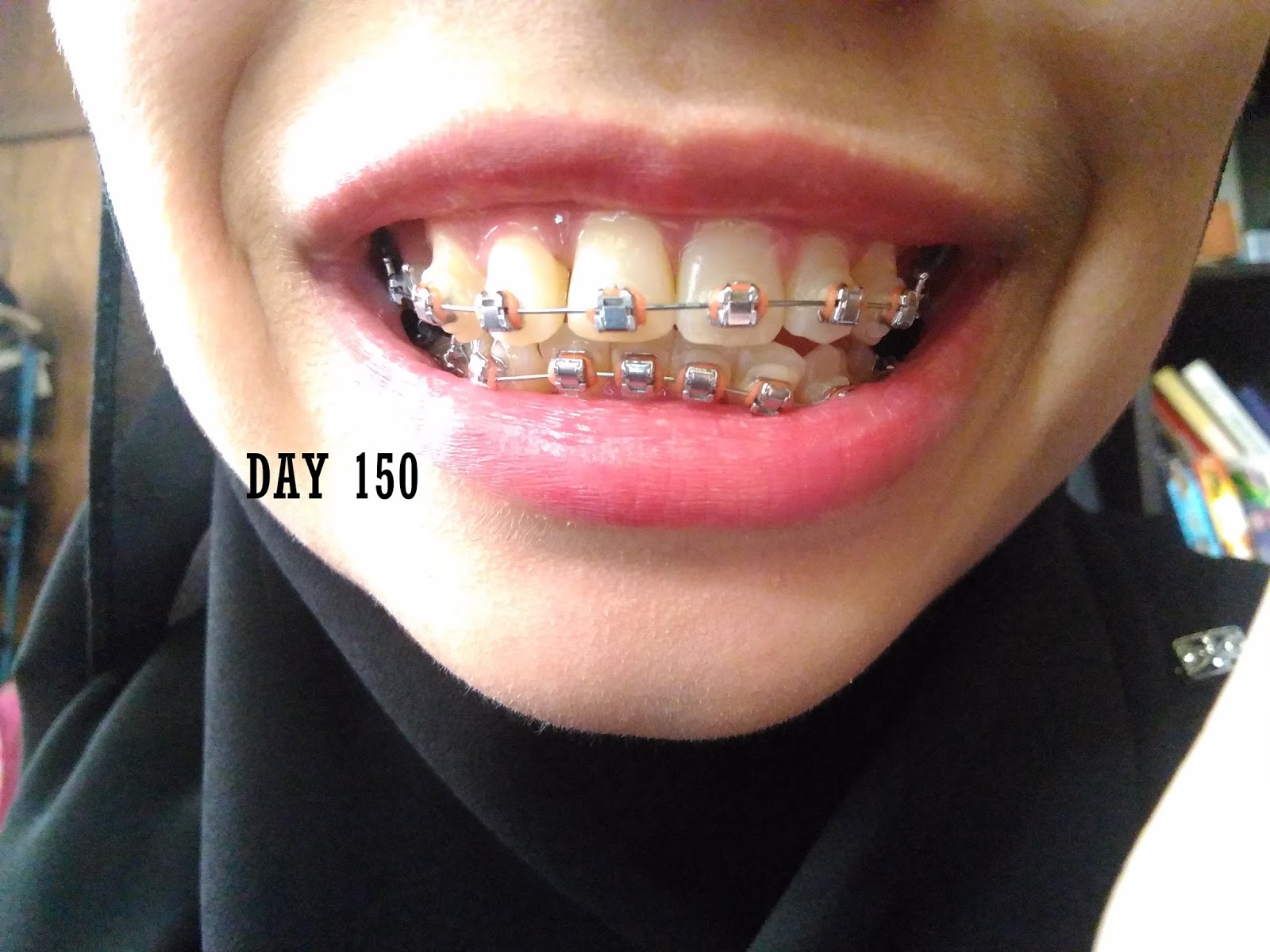 16+ Konsep Terkini Warna Yang Sesuai Untuk Braces