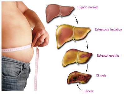 Steatoza hepatica: simptomele ficatului gras si tratamentele eficiente | coronatravel.ro