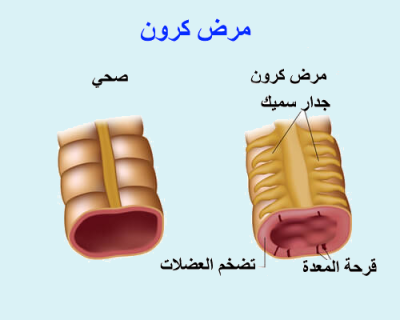 اعراض مرض كرون