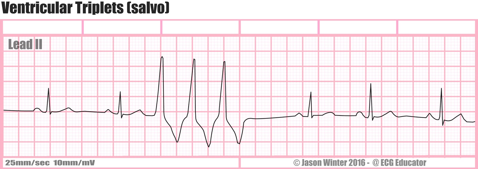 ECG Educator Blog Ventricular Triplets (salvo)