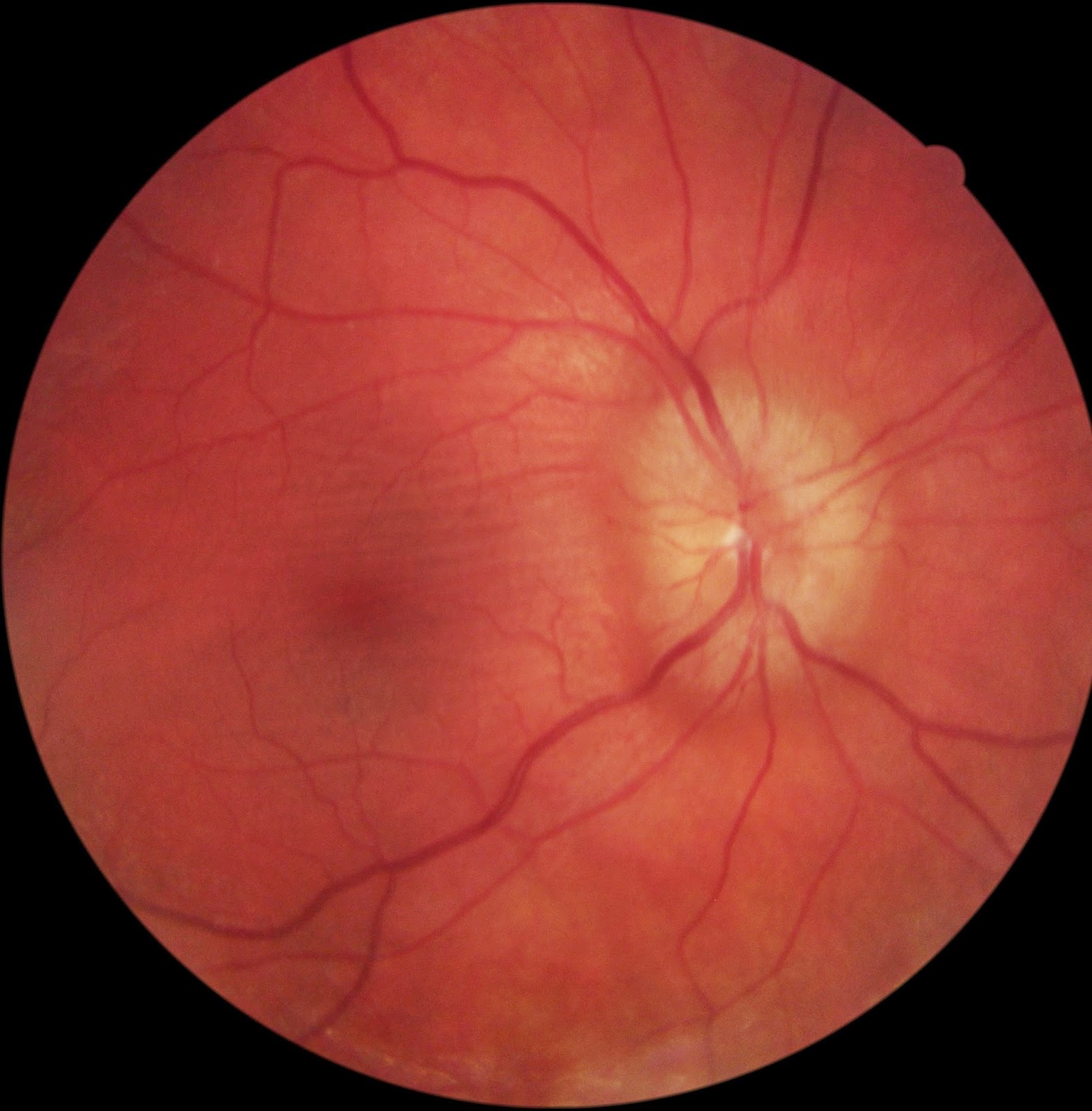Finding Multiple Sclerosis During Your Eye Exam Eyedolatry