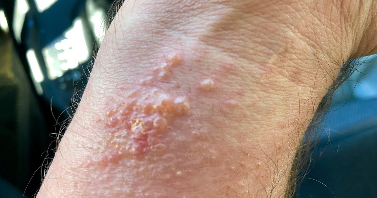 Traveling angler poison sumac