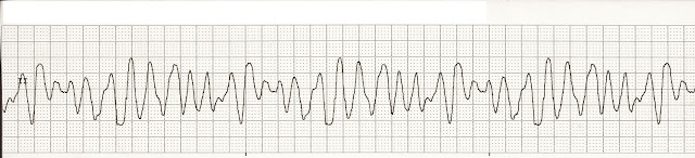 ACLS review: Pulseless VF/VT Part 1