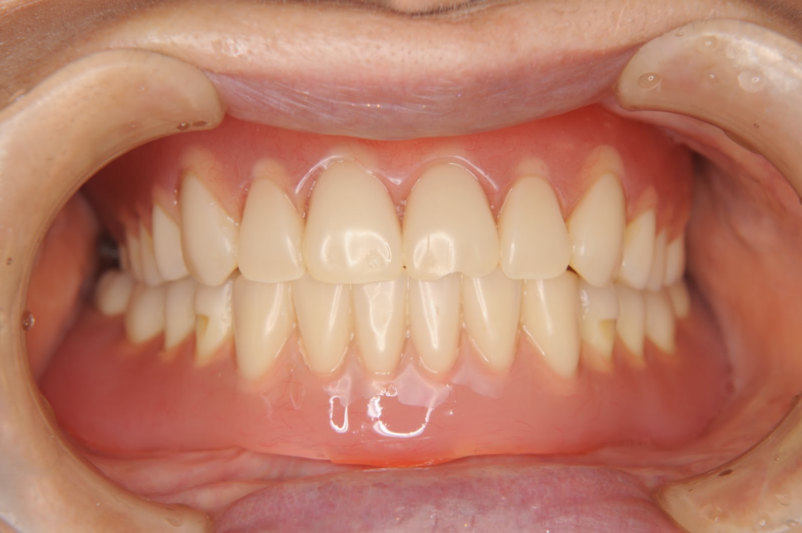 nagasima dental clinic 上下総入れ歯のインプラント症例（ケラターを使用して）