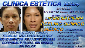 MARBELLA PEELING FACIAL QUIMICO MARBELLA PEELING FACIAL QUIMICO MEDICO PARA ELIMINACIÓN , QUITAR , TRATAMIENTO: ACNÉ , MARCAS , CICATRICES , MANCHAS ,PECAS , ESTRÍAS , MANCHAS