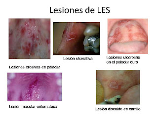 Úlceras orales LES
