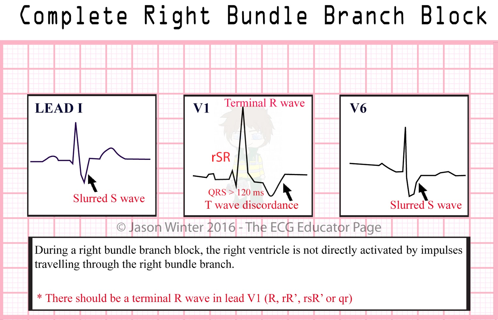ECG Educator Blog 03 09 16 ECG Educator Blog 03 09 16
