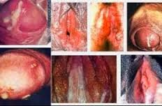 kencing nanah obat kencing nanah