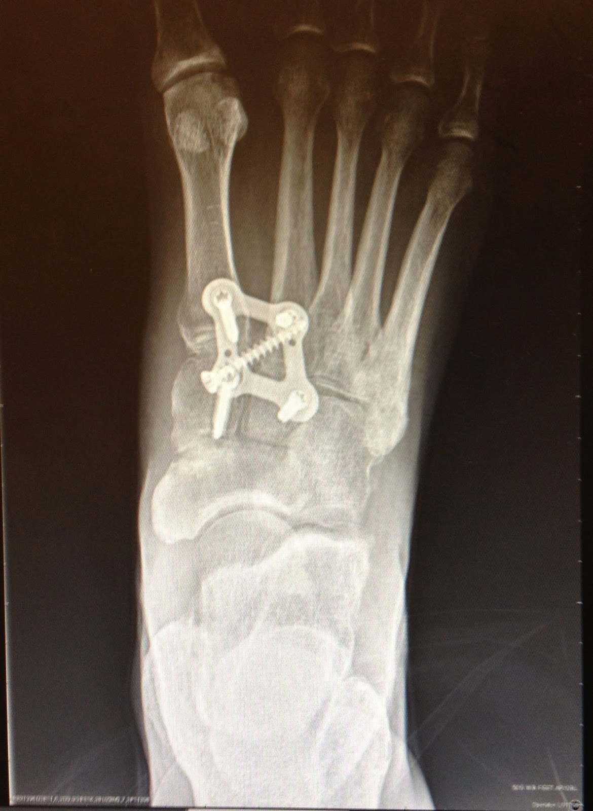 After LisFranc Surgery 12 weeks post lisfranc surgery Xrays
