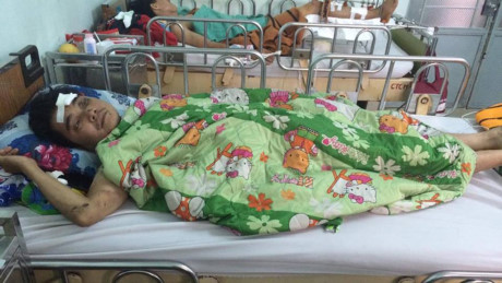 Nỗi ám ảnh của ca sĩ bị mất cánh tay sau tai nạn kinh hoàng - Ảnh 2 Noi am anh cua ca si bi mat canh tay sau tai nan kinh hoang - Anh 2