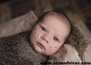 how to treat baby acne on face naturally