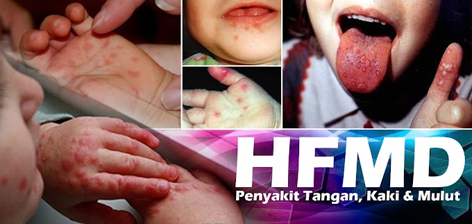 Penyakit Tangan, Kaki Dan Mulut (HFMD)