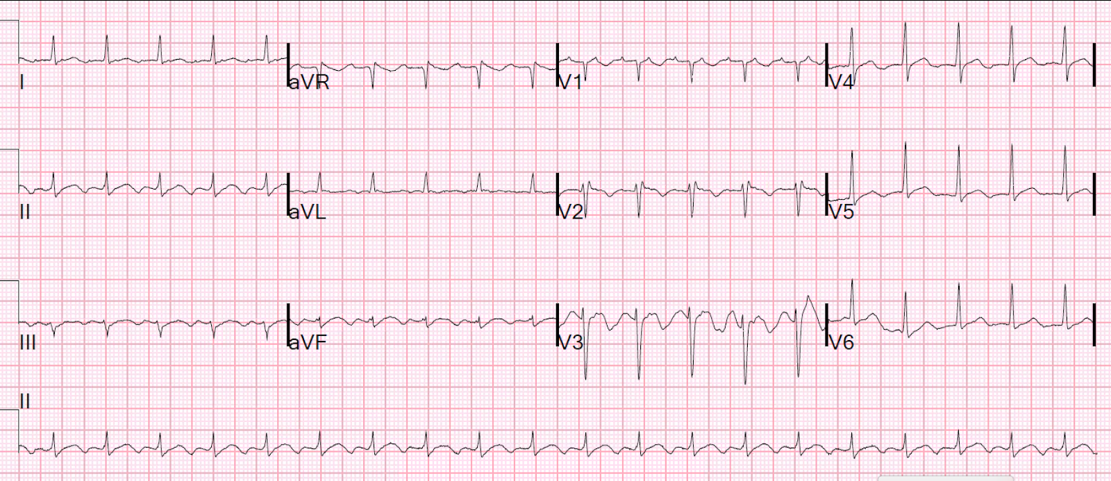 Dr. Smith's ECG Blog Sepsis with Pulmonary Edema and Elevated Right