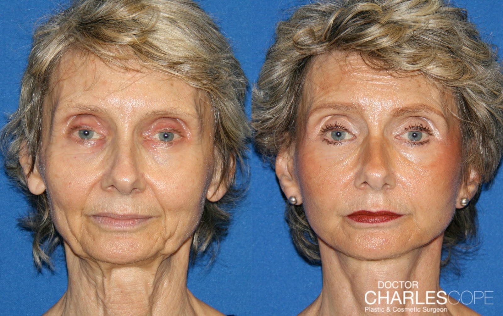7 TellTale Signs You Need Facelift Surgery Dr. Charles Cope