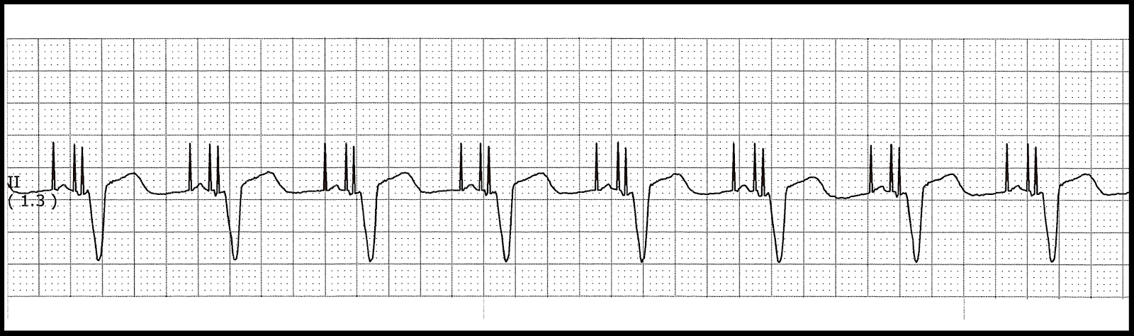 type ii atrial flutter icd 10 type ii atrial flutter icd 10