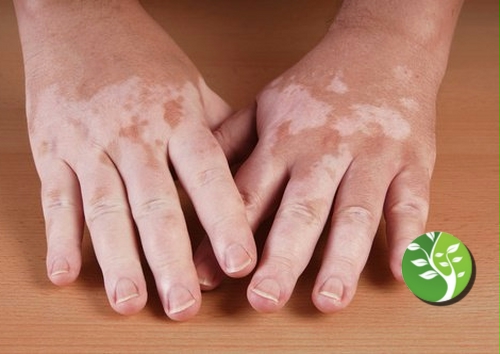 mejores remedios naturales para el tratamiento de El vitiligo  rápidamente