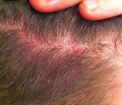 causes de l'acné du cuir chevelu - médical santé causes de l'acné du cuir chevelu - médical santé