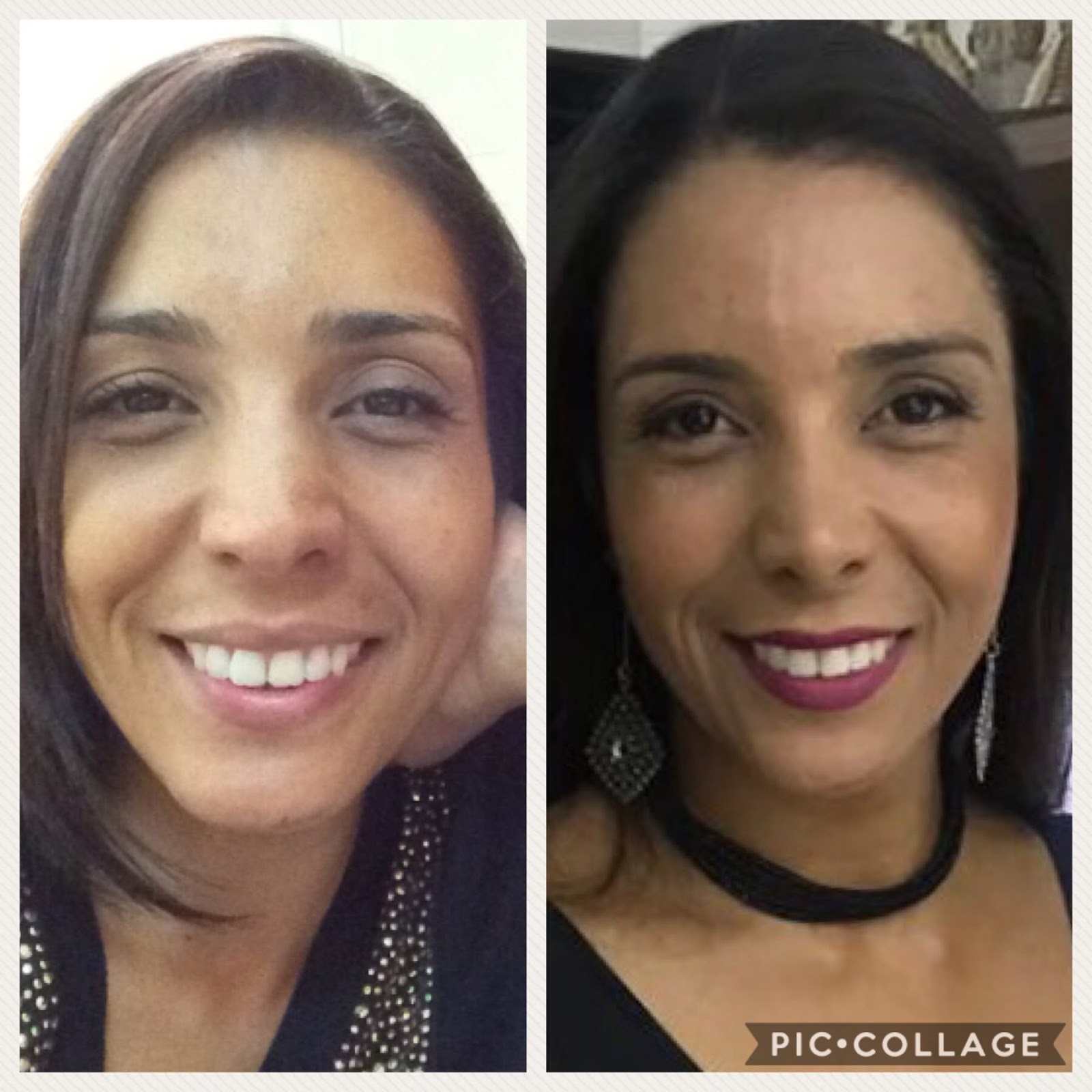 RINOPLASTIA antes e depois | A VIDA COMEÇA AOS TRINTA??