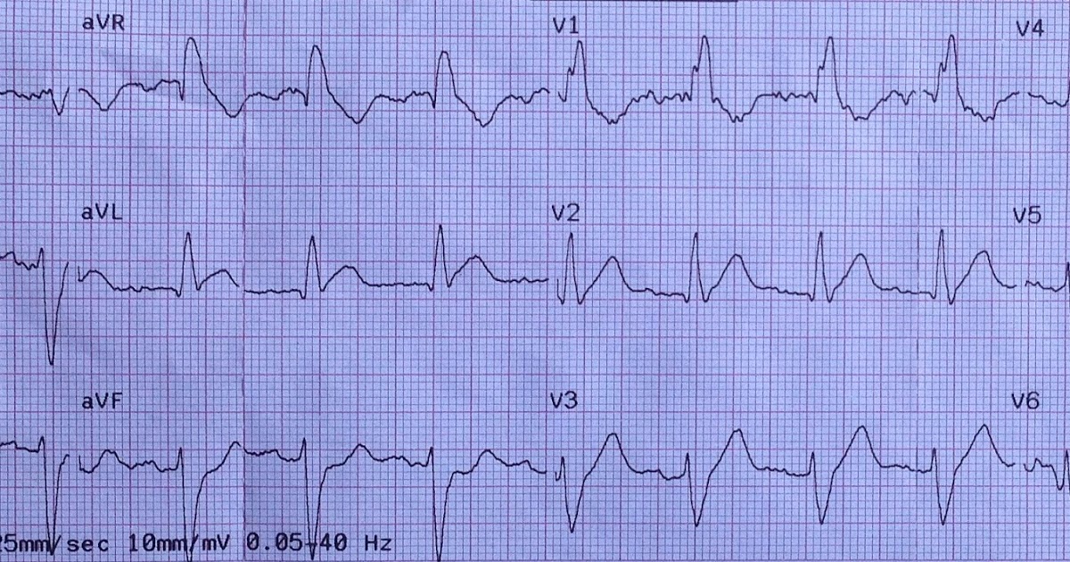 Dr. Smith's ECG Blog Chest Pain and Right Bundle Branch Block
