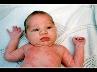Obat Herpes untuk Bayi Ampuh