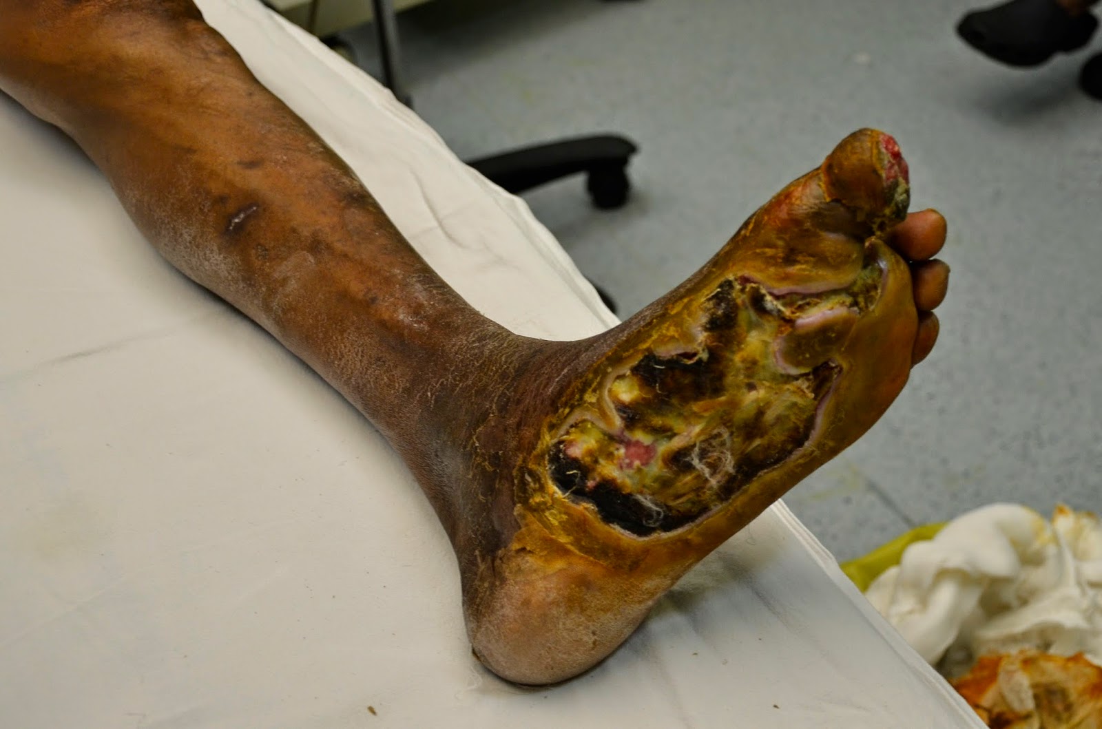 Dry gangrene | definition of dry gangrene by Medical ...