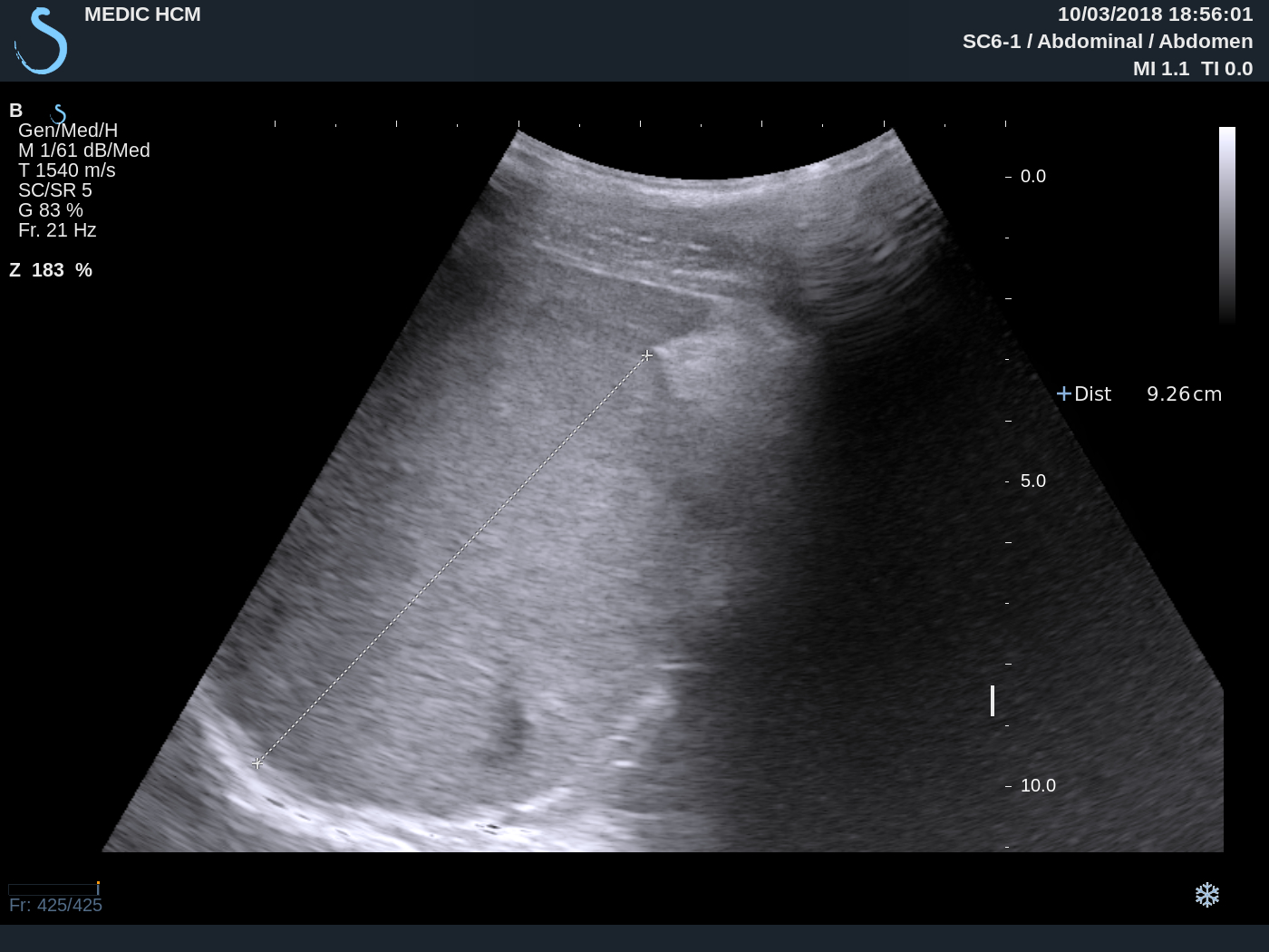 VIETNAMESE MEDIC ULTRASOUND CASE 484 SPLEEN TUMOR, Dr PHAN THANH HẢI