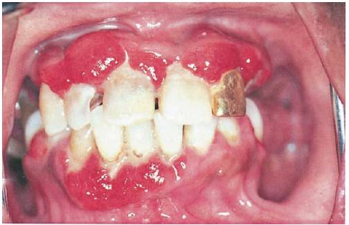 Natural Cure Gingivitis Cats Natural Cure Gingivitis Cats