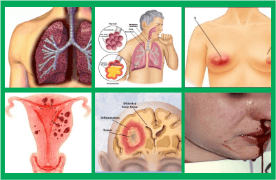aturan pakai cara mencegah kanker di tenggorokan harga murah, apakah ini yang cara menghilangkan kanker lever murah, hrga skrg obat herbal kanker ganas di leher ekonomis