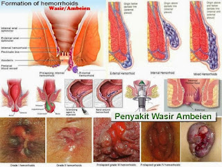 Nama obat wasir berdarah paling ampuh di apotik