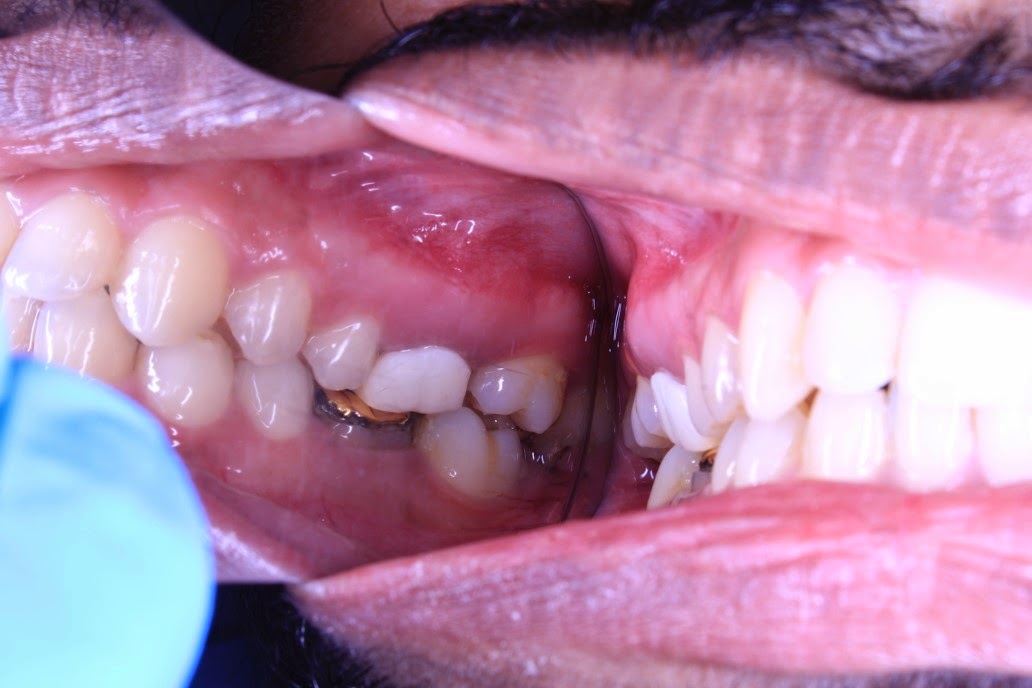 Upper decayed molar extraction and implant placement