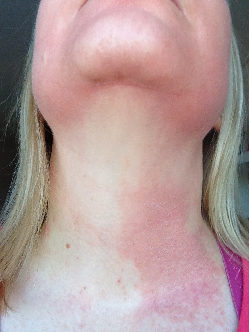 my-obagi-nu-derm-experience-week-3-finally-the-peeling-starts-to