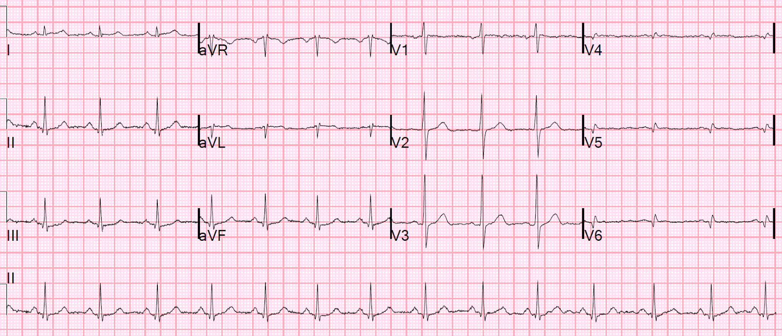 Dr. Smith's ECG Blog Persistent Chest Pain, an Elevated Troponin, and