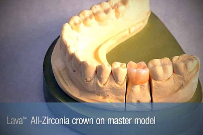 ZIRCONIA: How to seat a Lava™ All-Zirconia Monolithic Restoration