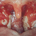 Mononucleose ou Doença do Beijo depois de ver isso você vai evitar sair beijando todo mundo na balada!