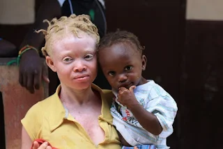 In Africa selling albino body parts is a money-making business.