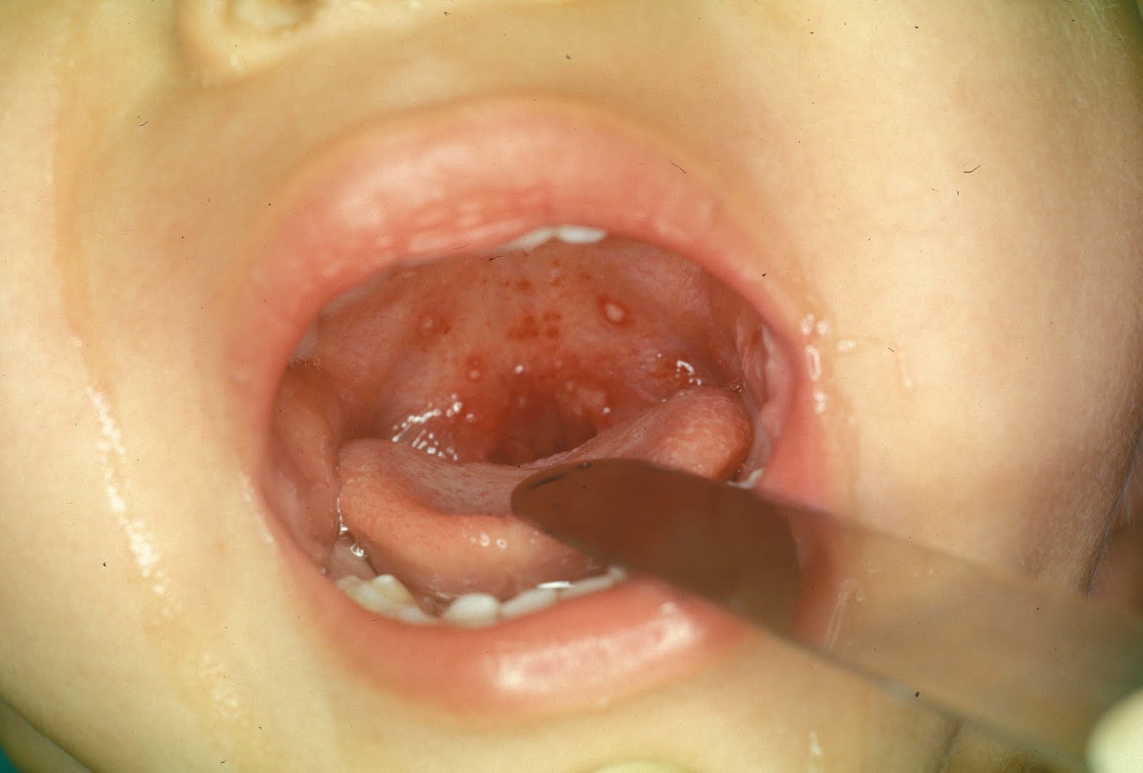 Fever Blister In Throat 89