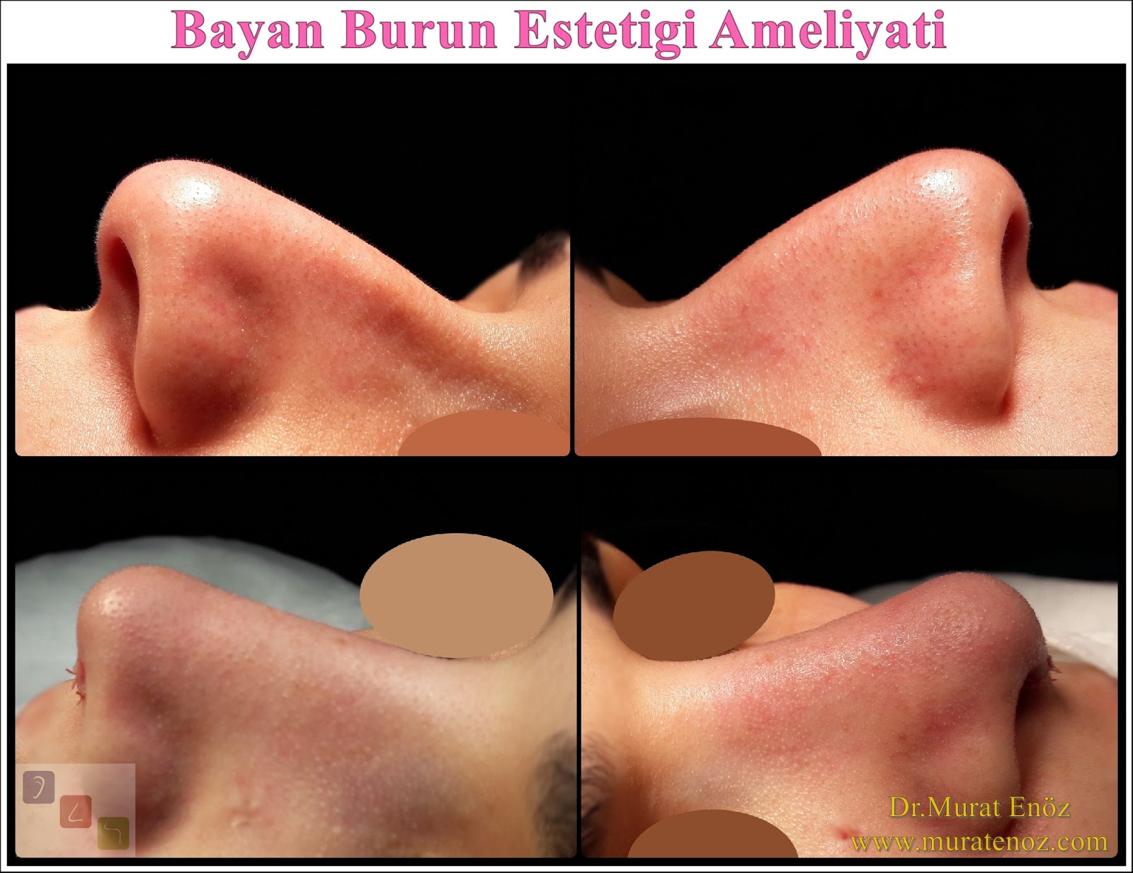 Bayan Burun Estetiği Ameliyatı