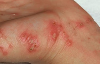 Obat Alami Eksim Basah Membandel