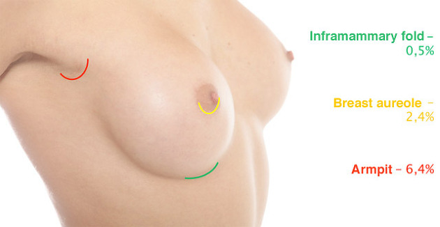 After Effects Of Breast Augmentation 90