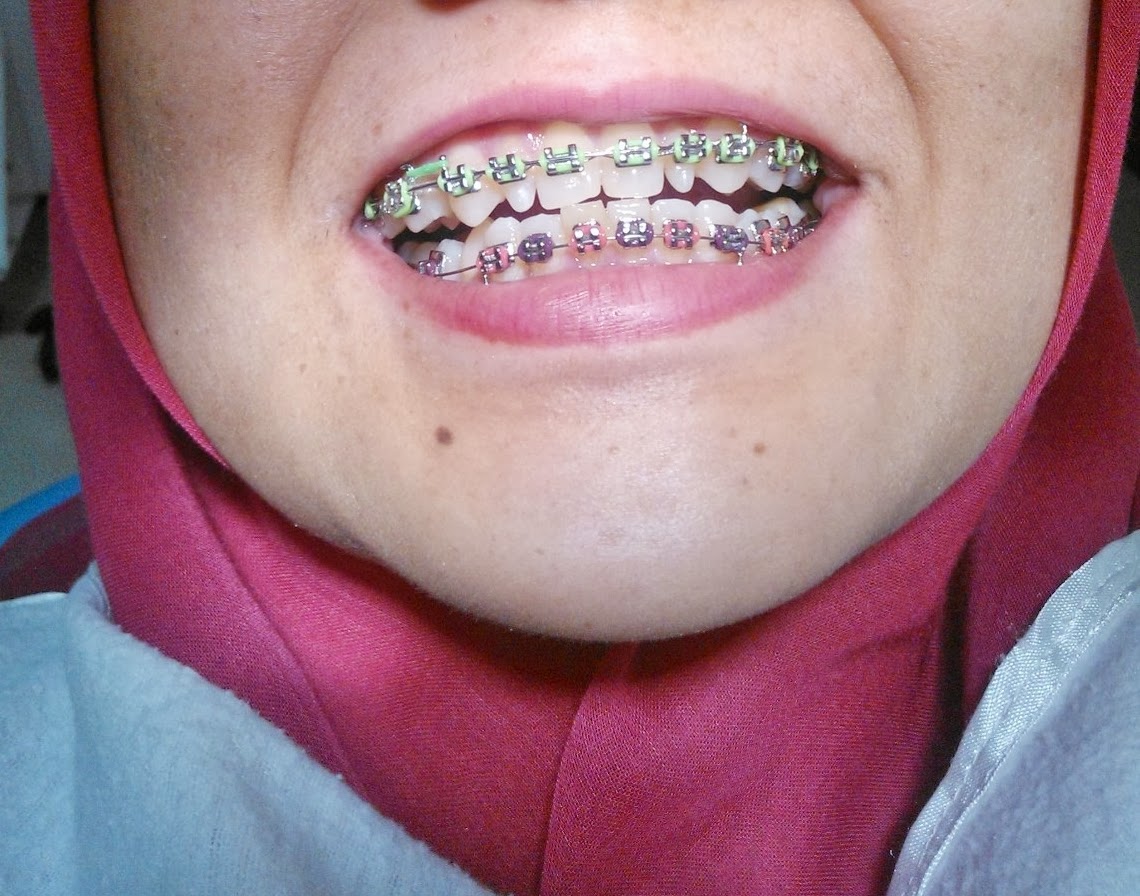 My Braces Elicy Braces on MaySept 2013