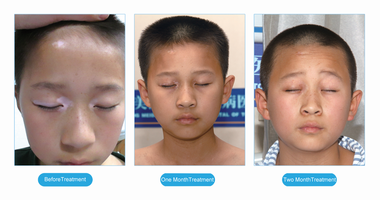 Chines Medicine Treatment for Vitiligo White Patches on Skin and Vitiligo